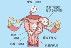 子宫肌瘤治疗手段以及手术介绍1